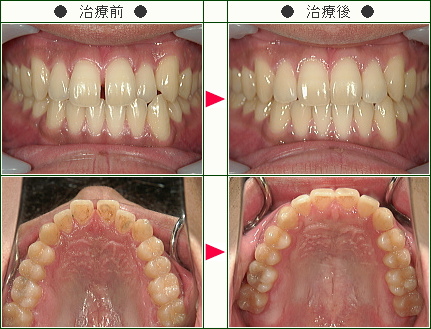 前歯のすきっ歯矯正症例(Ｄ.Ｓ様　２４歳　男性)