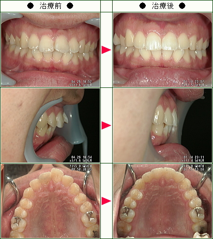 出っ歯矯正症例(Ｅ様　１９歳　男性)