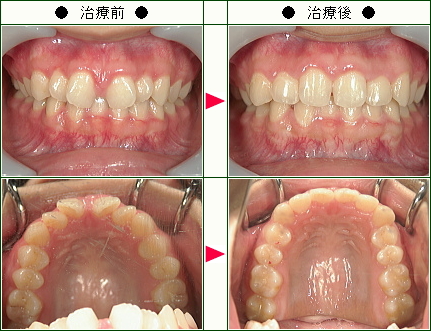 歯のデコボコ矯正症例(Ｅ様　２１歳　女性)