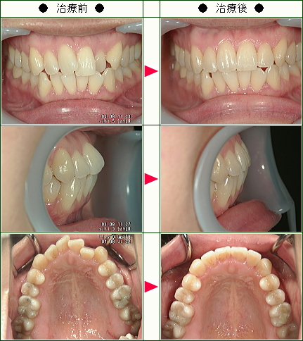 歯のデコボコ矯正症例(Ｅ様　３２歳　女性)