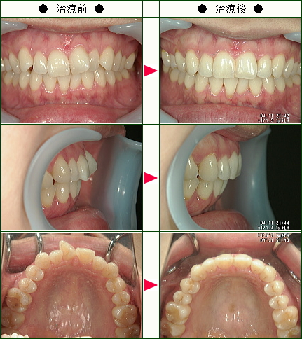 歯のデコボコ矯正症例(Ｅ.Ａ様　３４歳　女性)