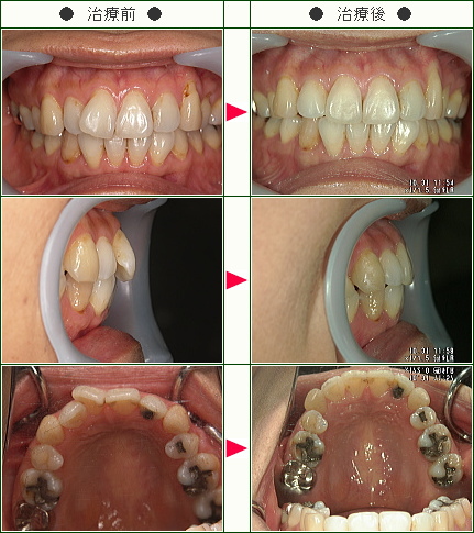 歯のデコボコ症例(えふ様　５２歳　女性)