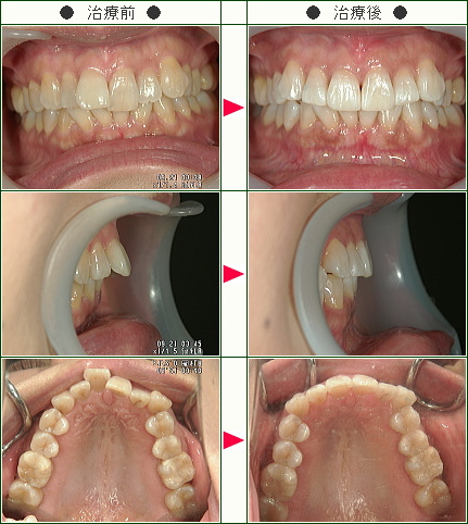 出っ歯矯正症例(Ｅ.Ｈ様　４２歳　女性)