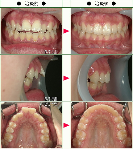 出っ歯矯正症例(Ｅ・Ｉ様　１６歳　女性)