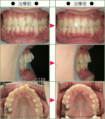 歯のデコボコ矯正症例(Ｅ・Ｉ様　２８歳　女性)