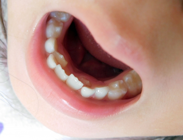 先天的な永久歯欠損の特徴