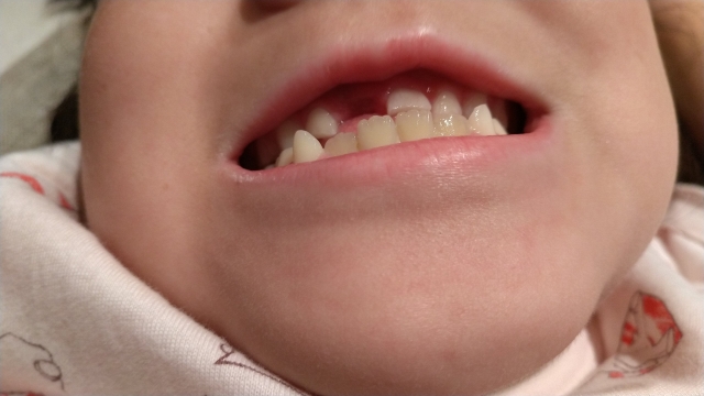 永久歯欠損である可能性が高い要素