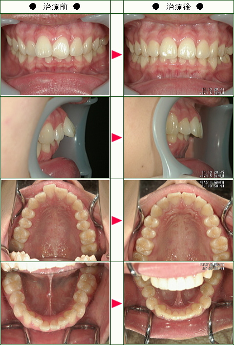 出っ歯矯正症例(Ｅ・Ｋ様　２１歳　女性)