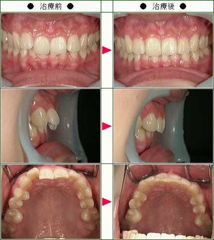 歯のデコボコ矯正症例(Ｅ.Ｋ様　２５歳　女性)