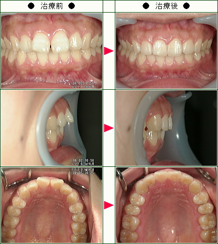 出っ歯矯正症例(Ｅ・Ｋ様　２８歳　女性)