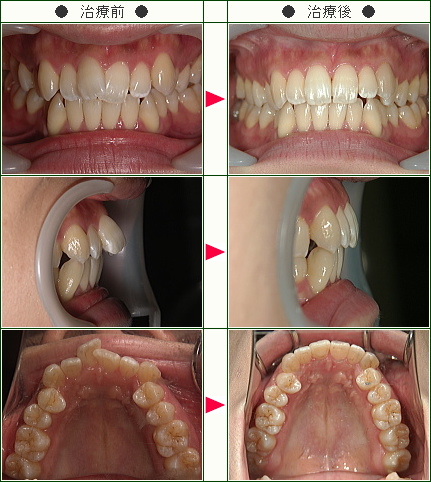 列 いい やめた 歯 矯正 ほうが 歯医者が教える「歯を削らない方が歯が長持ちする」の本当と嘘