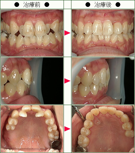 歯のデコボコ矯正症例(Ｅ.Ｋ様　４４歳　女性)