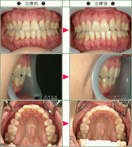 出っ歯矯正症例(Ｅ.Ｋ様　４６歳　女性)