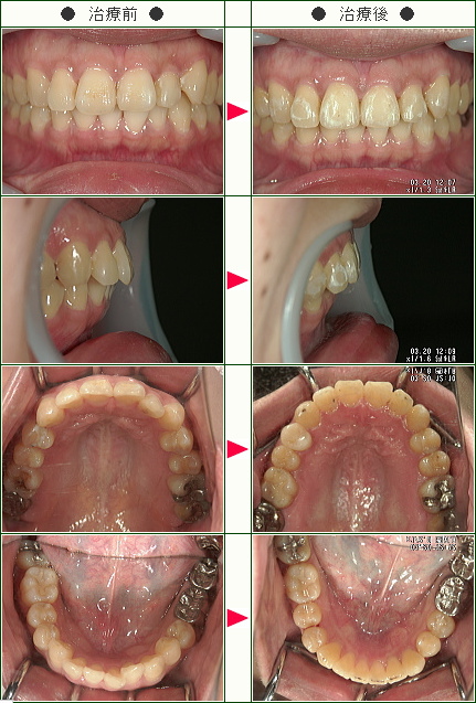 歯のデコボコ矯正症例(Ｅｌｌｙ様　３６歳　女性)