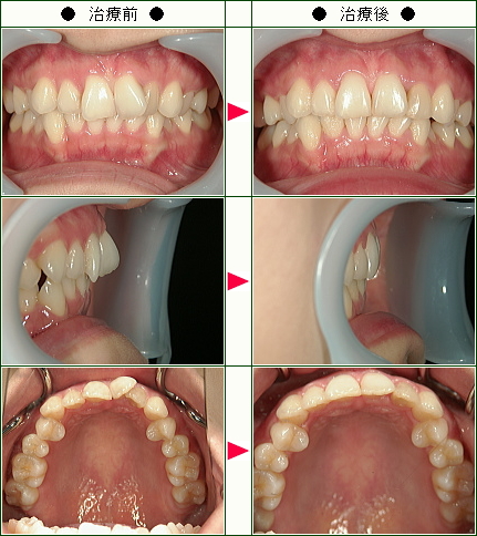 歯のデコボコ矯正症例(ｅｍ様　２７歳　女性)