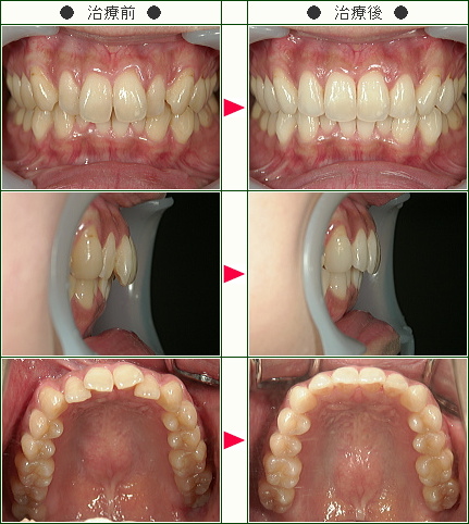 歯のデコボコ矯正症例(Ｅ.Ｏ様　２８歳　女性)