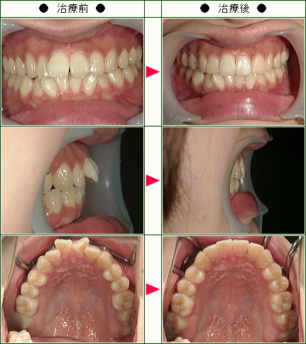 歯のデコボコ矯正症例(えり様　２２歳　女性)
