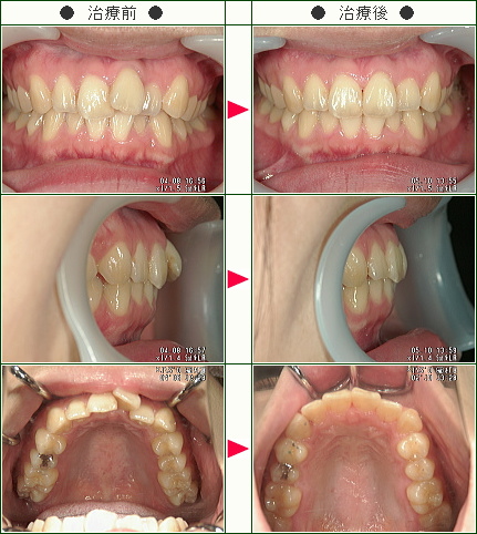 歯のデコボコ矯正症例(Ｅｒｉ様　２４歳　女性)