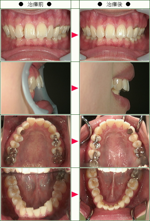 歯のデコボコ矯正症例(ＥＲＫ様　２７歳　女性)