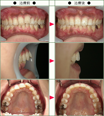 出っ歯矯正症例(Ｅ・Ｓ様　３５歳　女性)