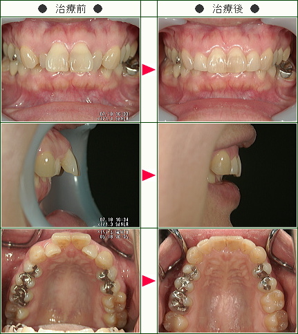 出っ歯矯正症例(Ｅ・Ｓ様　３６歳　女性)