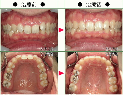 歯のデコボコ矯正症例(エス様　３０歳　女性)
