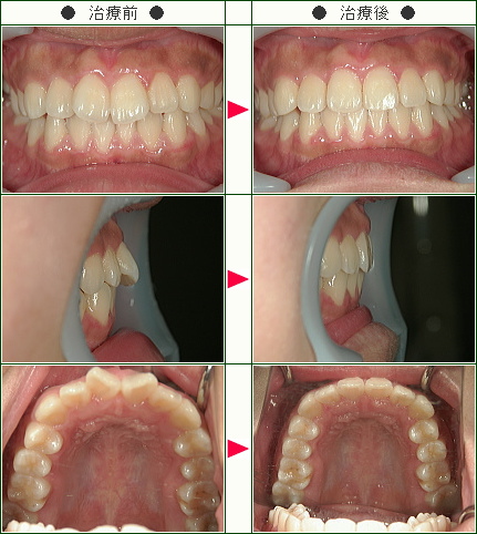 出っ歯矯正症例(Ｅ.Ｔ様　１６歳　女性)