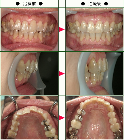 歯のデコボコ矯正症例(Ｅ.Ｔ様　４６歳　女性)