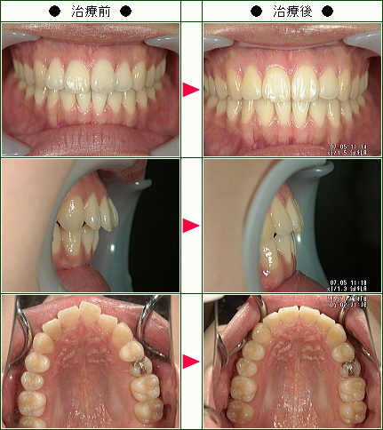 出っ歯矯正症例(Ｆ様　２２歳　女性)