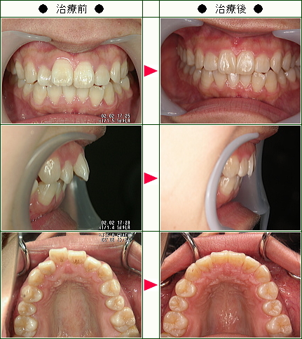 歯のデコボコ矯正症例(Ｆ様　２４歳　女性)