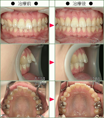 歯のデコボコ矯正症例(Ｆ様　２５歳　女性)