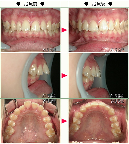 出っ歯矯正症例(Ｆ・Ａ様　１８歳　女性)