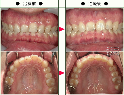 歯のデコボコ矯正症例(Ｆ・Ｋ様　２９歳　男性)