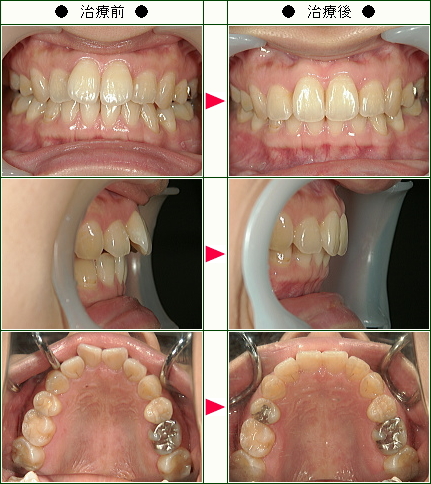歯のデコボコ矯正症例(Ｆ.Ｍ様　３４歳　女性)