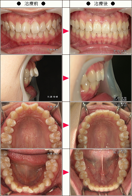 歯のデコボコ矯正症例［ＦＳ様　女性］