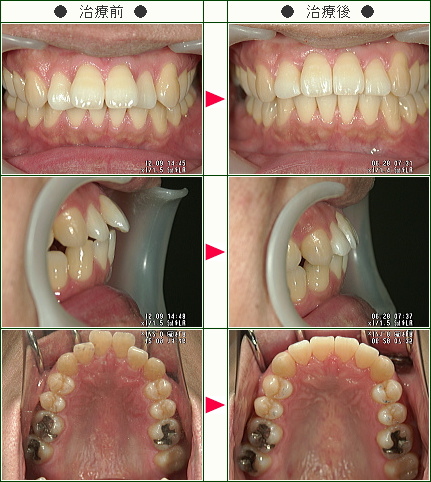 歯のデコボコ矯正症例(ゲン様　３３歳　男性)