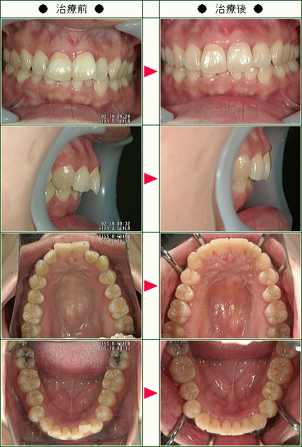 歯のデコボコ矯正症例(げんき様　３６歳　女性)