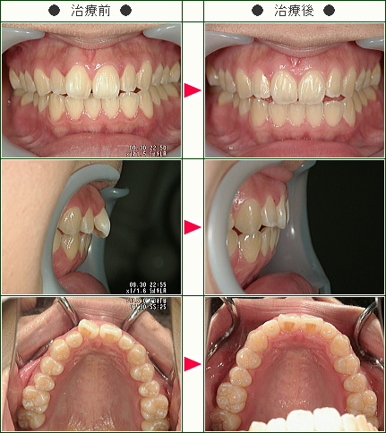 歯のデコボコ矯正症例(後藤様　２４歳　女性)