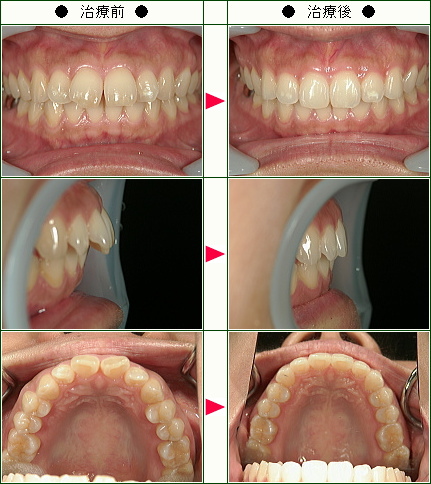 出っ歯矯正症例(後藤様　４６歳　女性)
