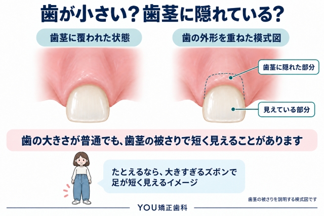 歯が小さい?歯茎に隠れている?