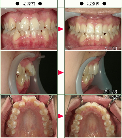歯のデコボコ矯正症例(Ｈ様　２５歳　女性)