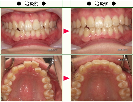 歯のデコボコ矯正症例(Ｈ様　３２歳　女性)