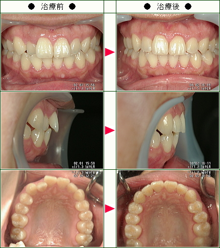 歯のデコボコ矯正症例(Ｈ．Ａ様　２８歳　女性)