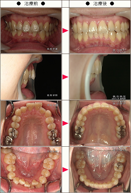 歯のデコボコ矯正症例［はっちゃん様　３４歳　女性］