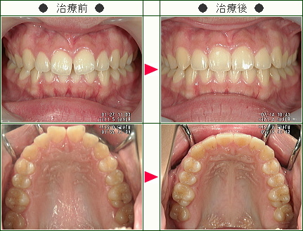 前歯のすきっ歯矯正症例(葉月様　２０歳　女性)
