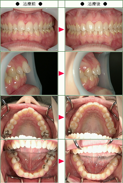 歯のデコボコ矯正症例(ＨＡＮＡ様　３４歳　女性 )