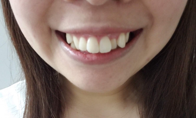矯正した方がよい歯並びの特徴