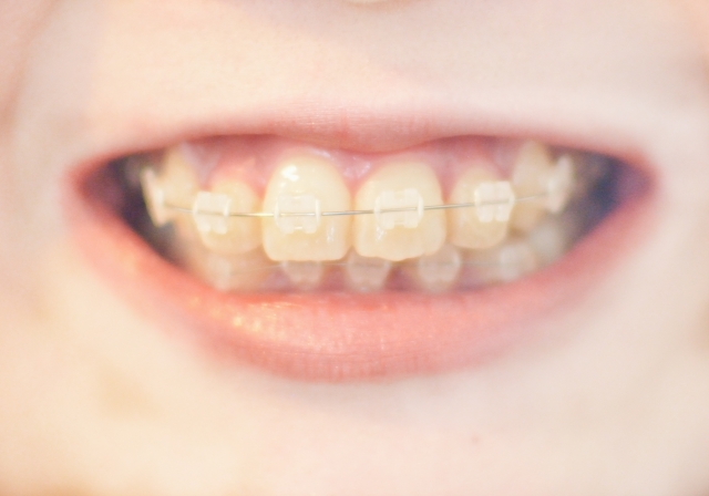 出っ歯の矯正をするとほうれい線が目立つ？