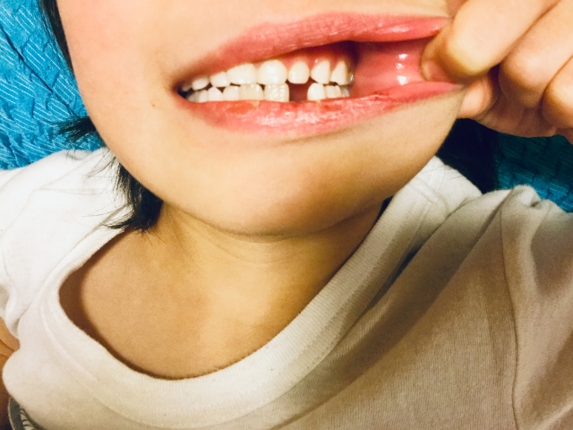 欠損歯の症状
