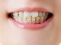 矯正中に痛みを感じる原因